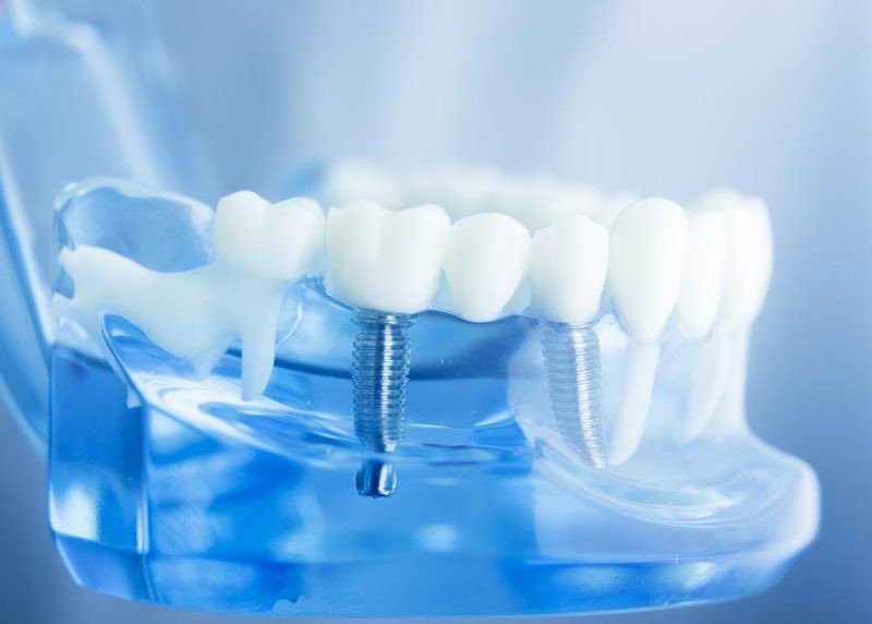 Cấy ghép Implant 5