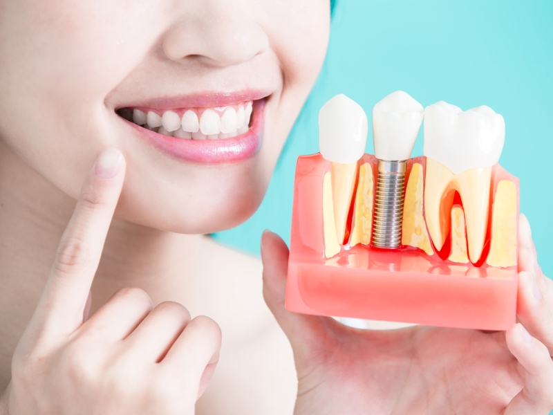 Cấy ghép Implant