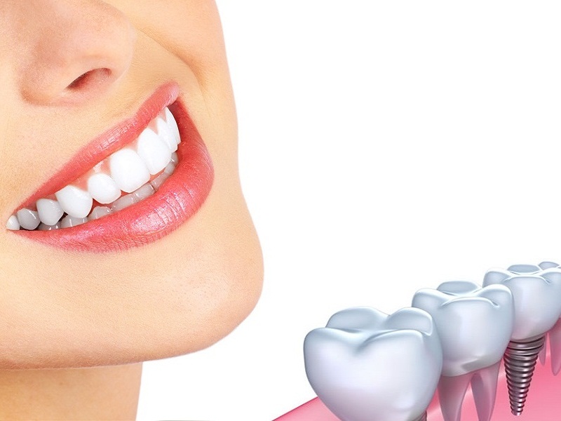 Cấy ghép Implant 3