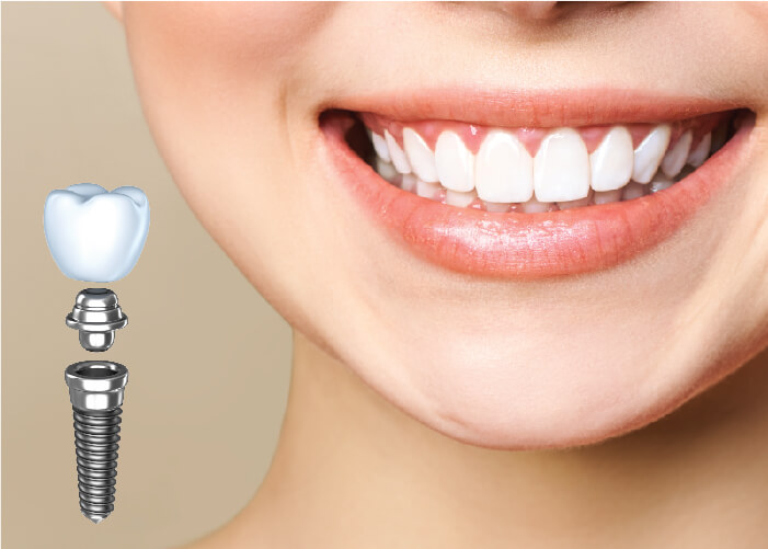 Cấy ghép Implant 4