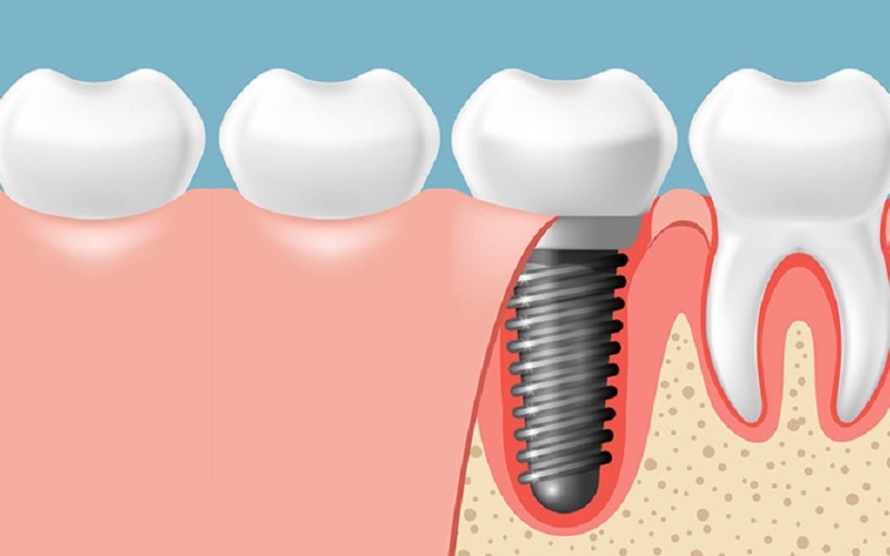 Cấy ghép Implant 1