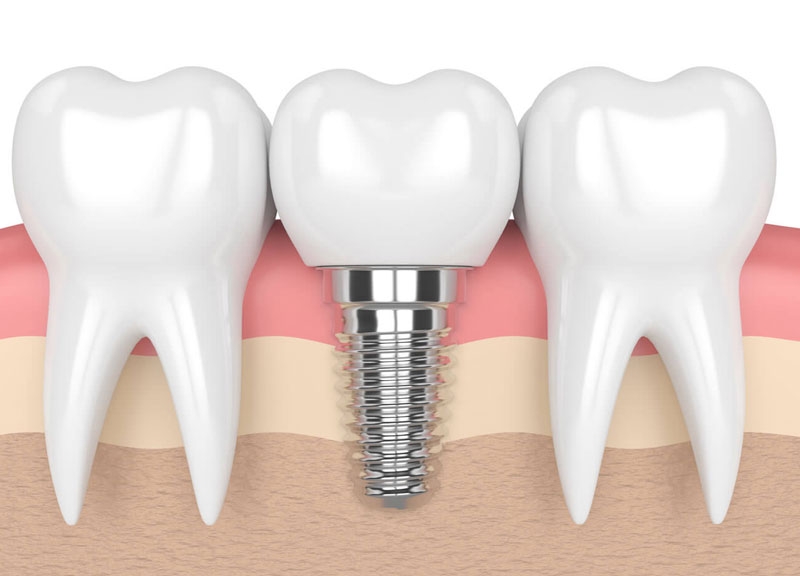 Cấy ghép Implant 2